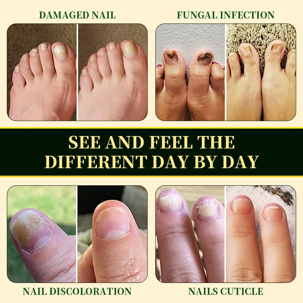 Common nail fungus concerns including damaged nails, fungal affected nails, discoloration, and unhealthy nail appearance shown in a comparison image