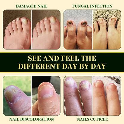 Common nail fungus concerns including damaged nails, fungal affected nails, discoloration, and unhealthy nail appearance shown in a comparison image