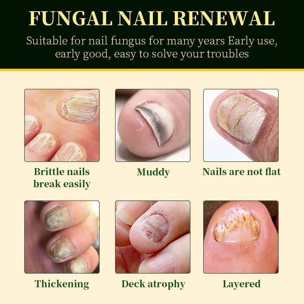 BeamBalm nail fungus solution for common nail concerns including brittle nails, thick nails, damaged nails, and uneven nail texture